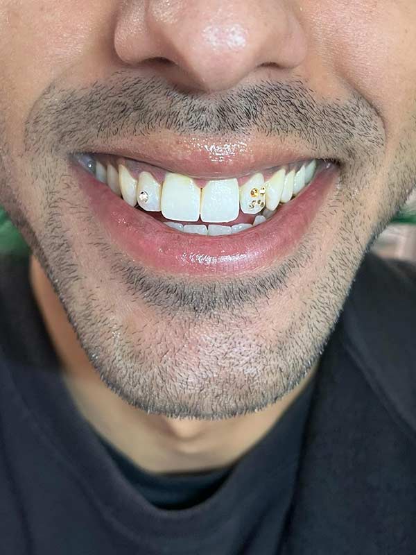 A client with Charmed Smile tooth gems